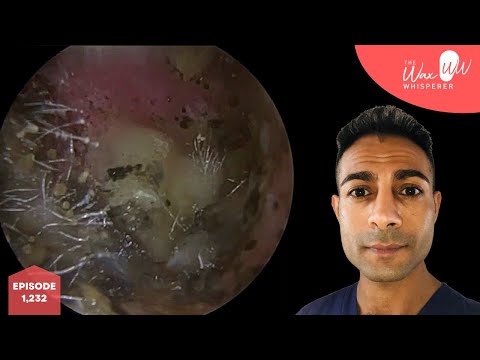 Видео: 1,232 - Очистка уха от грибковых спор