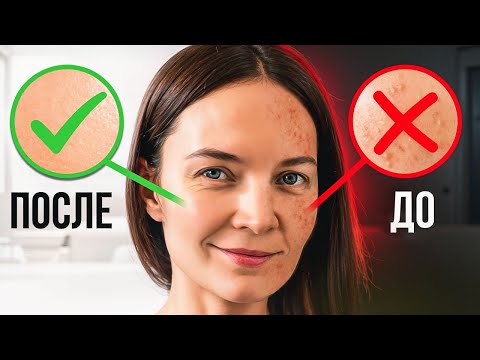 Видео: 😱🆘Мое лицо было в ужасных прыщах: врачи не помогли. История моего спасения без дорогих препаратов