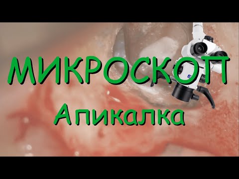 Видео: Апикальная хирургия. Микроскоп.