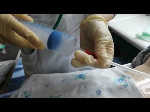 Видео: Алгоритм кормление через гастростому