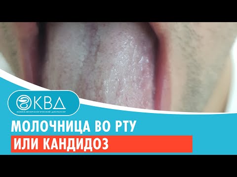 Видео: Молочница во рту или кандидоз. Клинический случай №107