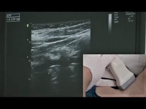 Видео: Мастер класс Носенко Е.М. Ультразвуковое исследование сосудов на шее. ЦДС МАГ. ЦДС БЦА.