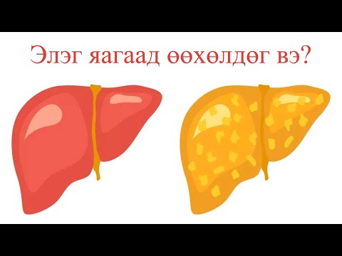 Видео: элэг өөхлөлтийг тоохгүй байвал юу болох вэ?