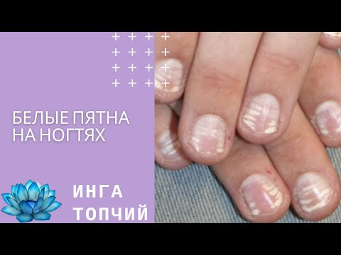 Видео: Белые пятна на ногтях пальцев рук.