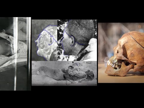 Видео: Перевал Дятлова. Две серии фотографий из морга.  Тело неизвестного. Странности черепа Золотарева