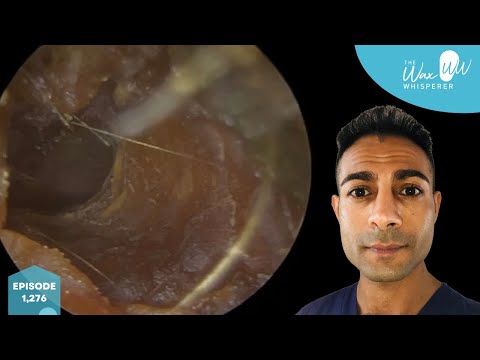 Видео: 1,276 - Невероятно зудящая отслоившаяся омертвевшая кожа в ухе