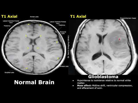 Видео: МРТ головного мозга: норма и глиобластома: результаты контрастной визуализации T1 и T1 | Агрессив...
