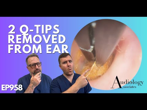 Видео: 2 ватные палочки извлечены из уха - EP958