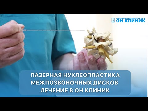 Видео: Лазерная нуклеопластика межпозвоночных дисков лечение в ОН КЛИНИК