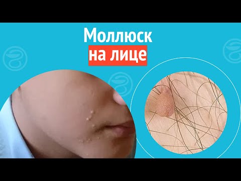 Видео: 😕 Моллюск на лице. Клинический случай №1109