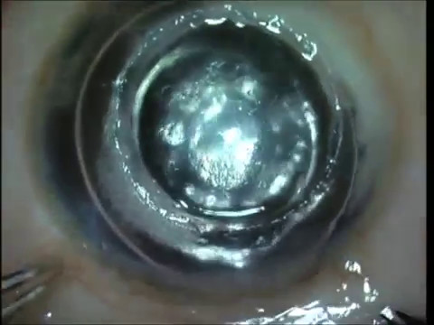 Видео: DALK - глубокая передняя послойная кератопластика при кератоконусе