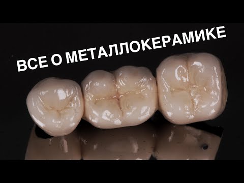 Видео: Металлокерамика. Главные минусы. Что такое гирлянда и плечевая масса?