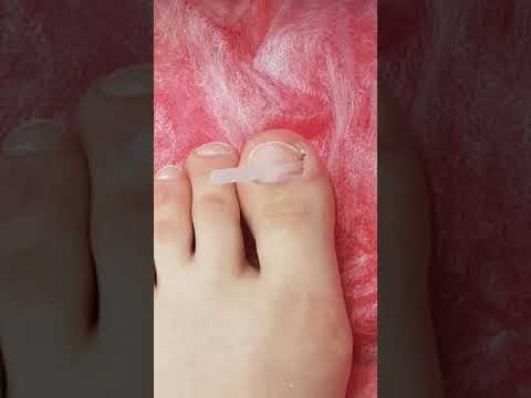 Видео: Установка пластины Подострайп при лечении вросшего ногтя - Подолог Сумы