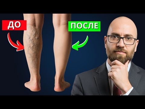 Видео: 5 КЛЮЧЕЙ, чтобы ИЗБЕЖАТЬ ВАРИКОЗА – Что подтверждает современная наука