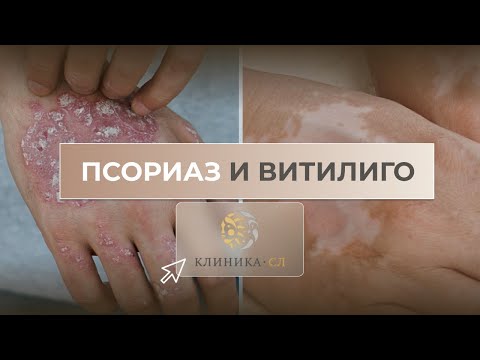 Видео: Псориаз и Витилиго