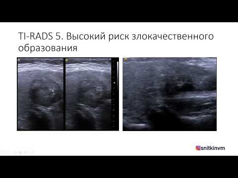 Видео: ИСПОЛЬЗОВАНИЕ TI-RADS (ТИРАДС) В ПРАКТИКЕ ВРАЧА УЛЬТРАЗВУКОВОЙ ДИАГНОСТИКИ. Часть 2.