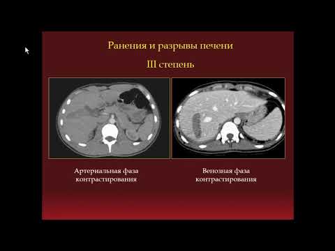 Видео: Михайловская Е.М. «Неотложная КТ-диагностика ранений печени и селезёнки»