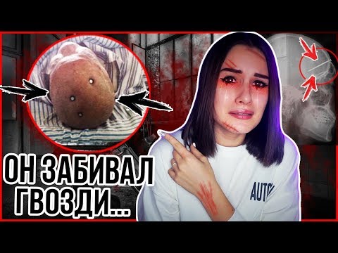 Видео: ЗАБИВАЛ ГВОЗДИ СЕБЕ В ГОЛОВУ! БОЛЬНОЙ ПАЦИЕНТ! УЖАСНАЯ ИСТОРИЯ!