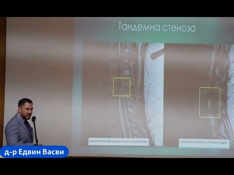 Видео: Лумбална спинална стеноза   Др Едвин Васви