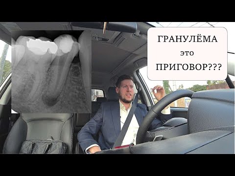 Видео: Гранёлема | Нужно ли удалять зуб?