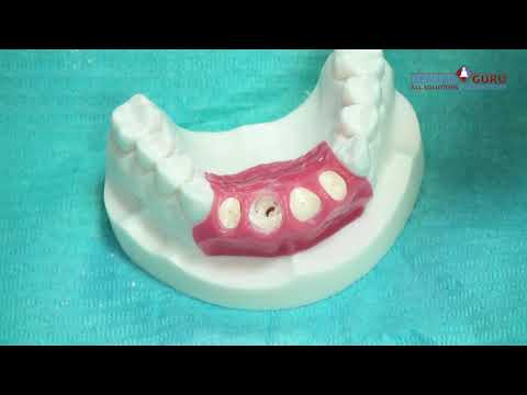 Видео: Методика "корневого щита" (socket shield).