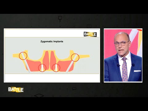 Видео: Хирургические сложности при полной потере зубов объемная реконструкция кости или скуловые имплантаты