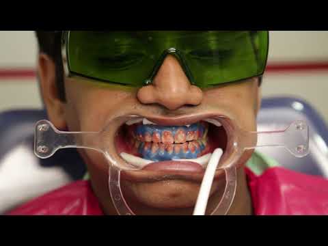 Видео: Офисное отбеливание