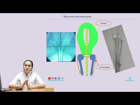 Видео: Химиолучевая терапия с профилактическим облучением парааортальных лимфоузлов при раке шейки матки