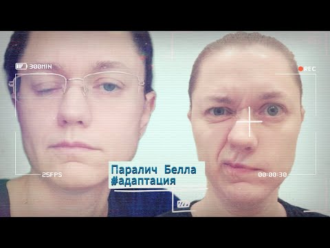 Видео: Паралич лицевого нерва (паралич Белла). Адаптация к жизни в новых условиях (2)