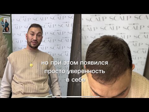 Видео: Отзыв клиента после Микропигментации/Трихопигментации спустя год SMP Scalpmicropigmentation