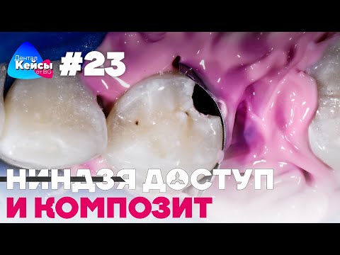 Видео: Ниндзя доступ и композит  | Дентал Кейсы от BG #23