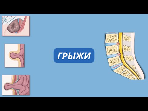 Видео: что такое грыжа? виды и лечение