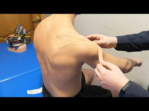 Видео: Наложение кинезио тейпа при синдроме замороженого плечя