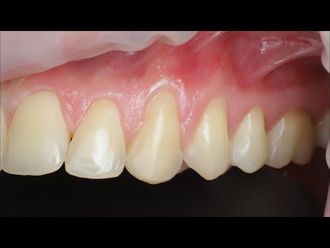 Видео: Закрытие множественных рецессий десны, пластика десны, T-CAF gum recessions closure surgery