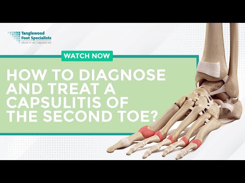 Видео: Как диагностировать и лечить капсулит второго пальца стопы