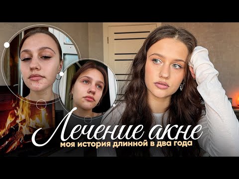 Видео: МОЯ ИСТОРИЯ АКНЕ: прыщи длиною в 2 года!