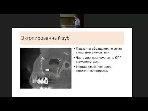 Видео: Атипичные варианты патологии околоносовых пазух у детей
