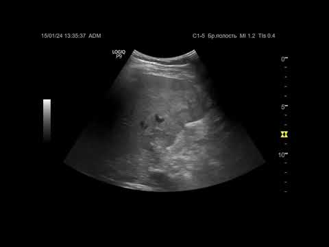 Видео: УЗИ. Доктор Иогансен. Видеопримеры. Выпуск 57. Опухоль поджелудочной железы с метастазами в печени.