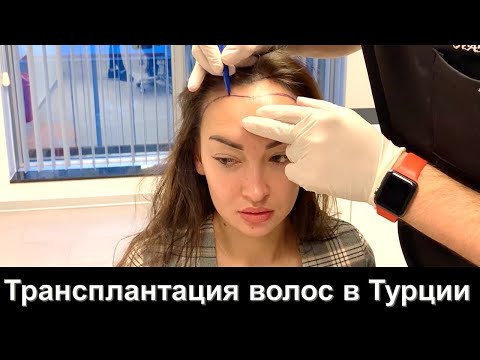 Видео: Трансплантация волос у женщин. Женская пересадка волос. Алопеция у женщин