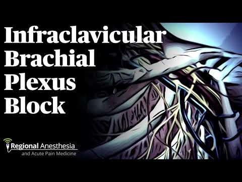 Видео: Підключична блокада плечового сплетення