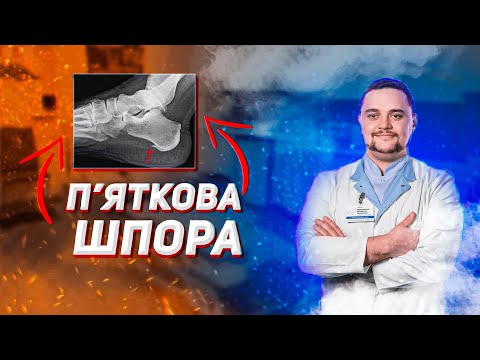 Видео: П'яткова шпора. Чому болить і як лікувати.