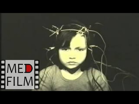 Видео: Генерализованные эпиприпадки, эпилепсия, лечение © Generalized seizures, epilepsy, treatment
