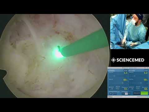 Видео: MoLEP/MOSES/Holmium Laser for BPH/Гольмиевая энуклеация простаты/68cc