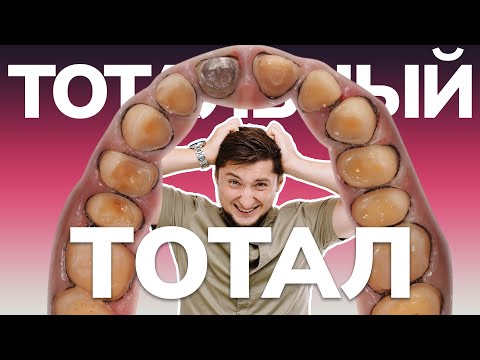Видео: Тотальный тотал - керамические виниры, накладки, культевые вкладки, коррекция десны. Дентал Кейсы