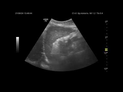 Видео: УЗИ. Доктор Иогансен. Видеопримеры. Выпуск 85. Цирроз печени (2).