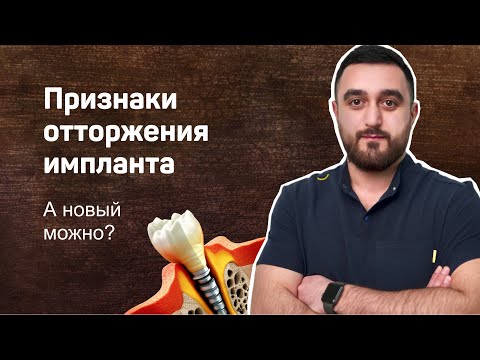 Видео: Зубной имплантат не прижился. Признаки + кейс отторжение импланта спустя 10 лет.