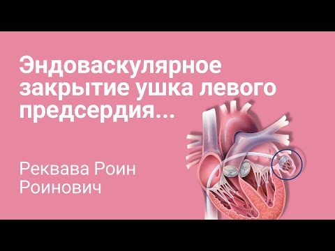 Видео: Закрытие ушка левого предсердия: секреты успешной установки!