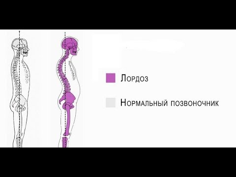 Видео: Как исправить гиперлордоз