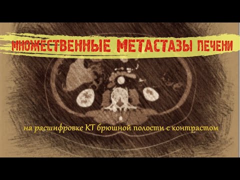 Видео: МЕТАСТАЗЫ в печени и АТЕРОСКЛЕРОЗ брюшной аорты на РАСШИФРОВКЕ КТ брюшной полости с контрастом
