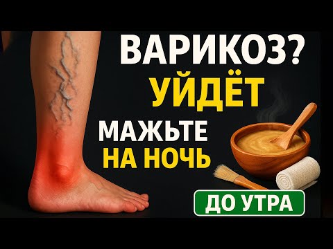 Видео: Невероятно, но варикоз лечится обычным средством на ночь